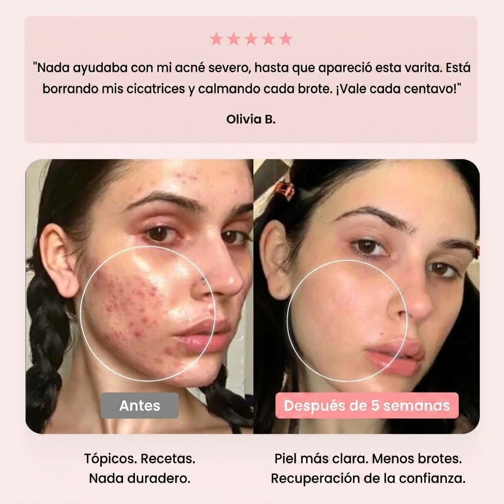 Máquina de Alta Frecuencia Facial Beauty Pro® — Trata el Acné desde su Origen | 4 Electrodos