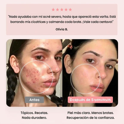 Máquina de Alta Frecuencia Facial Beauty Pro® — Trata el Acné desde su Origen | 4 Electrodos