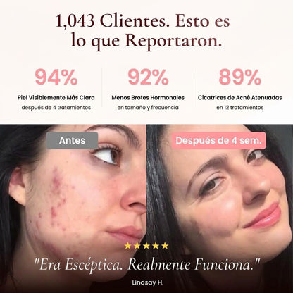 Máquina de Alta Frecuencia Facial Beauty Pro® — Trata el Acné desde su Origen | 4 Electrodos